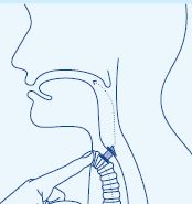 stemprothese